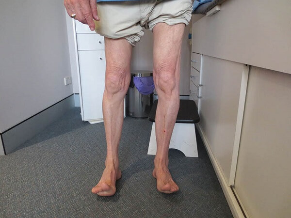 Thoát vị đĩa đệm gây teo cơ có điều trị khỏi được không ?